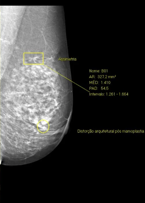 Mamografia em incidência LMLO com assimetria e distorção arquitetural marcadas no PACS da clínica.